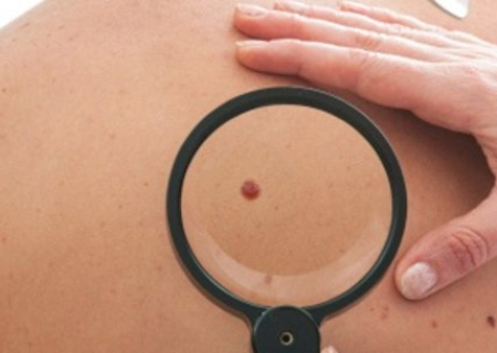 Campanha de prevenção do câncer de pele identifica 4 mil casos no país
