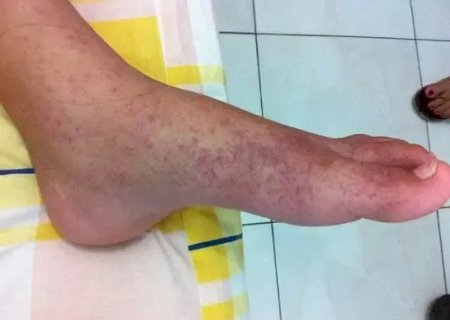 Com nova morte em Fátima do Sul, MS atinge recorde de óbitos por Chikungunya