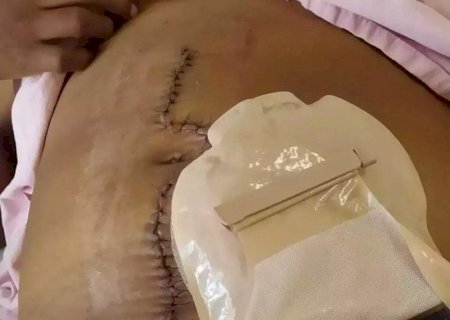 Mulher fica quatro meses com gaze esquecida no corpo após cesariana no HU-UFGD